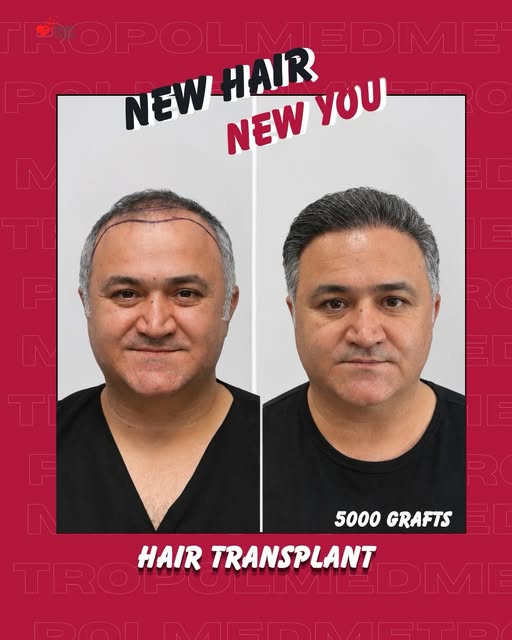 NEW HAIR. NEW YOU. ✨
A new chapter starts with the right plan.
This patient underwent a 5,000-graft 