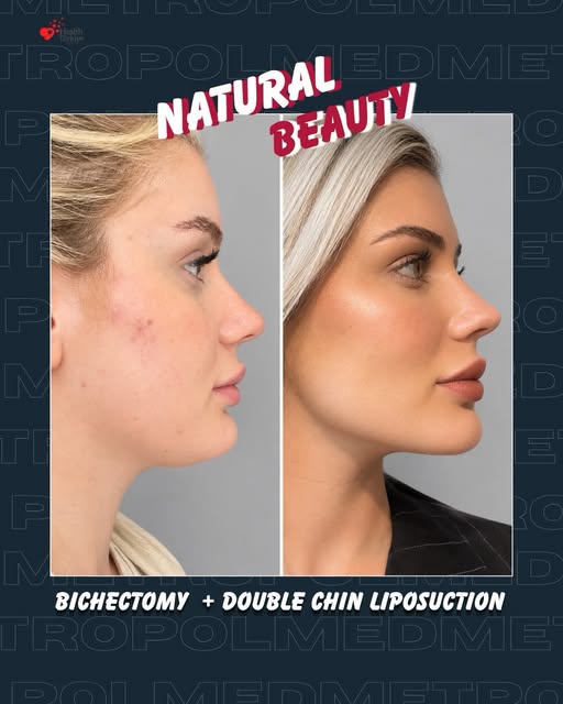 A more defined profile, while keeping it natural. ✨

This transformation combines bichectomy and dou