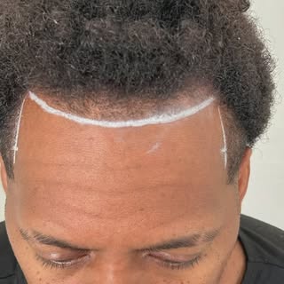 Before, During, After on this hairline enhancement! 😎

#scalpmicropigmentation #microhaarpigmentati