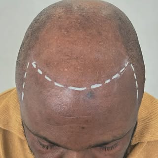 Before During and After!😎

Learned a lot during this one! 
Hyperpigmentation is a common thing in M
