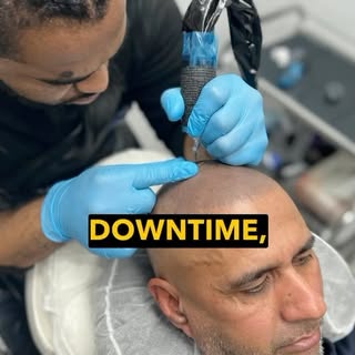 Hair transplant isn’t always successful for everyone, come and see how Scalp Micro Pigmentation coul