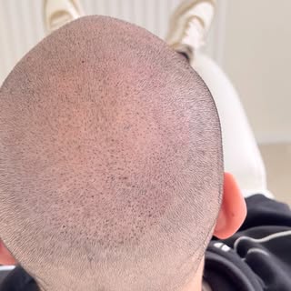 Before During And After. 1st To 3rd Session With A Client From Spain!😎

#scalpmicropigmentation #ha