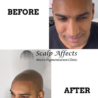 What is Scalp Micropigmentation (SMP)? 
The « Scalp Effect »
Scalp Micropigmentation (SMP), often ca