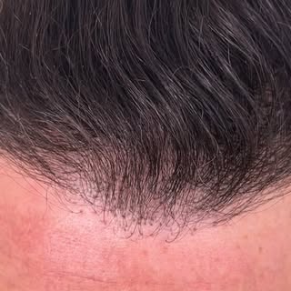 Before, During and After Scalp Micro Pigmentation.

I Did this session with a client from turkey who