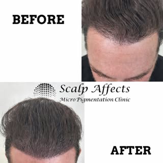 The Before and After.😎

Client had a hair transplant plant.

#smp #mhp  #scalpmicropigmentation #mi