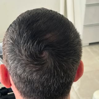 Before,During and After 😎 

Camouflaging hair thinning with density! This SMP things is amazing! 🤓