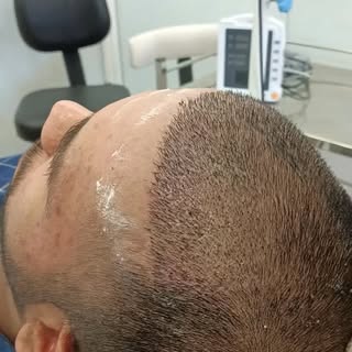 From thinning to winning 💯
Real results. Real confidence.
Only at @arnica_cosderma Clinic.

#hair #
