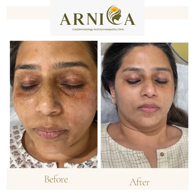 A clearer, more even-looking complexion

Before ➡️ After
A beautiful transformation following a pers