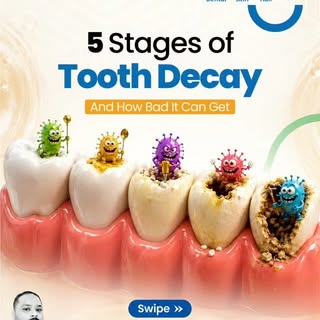 Tooth decay doesn’t happen overnight. It progresses through different stages—from healthy enamel to 