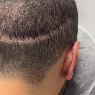 Can you even tell? 😎 Client had this old hair transplant scar for 10+ years 😱 He has thinning in o