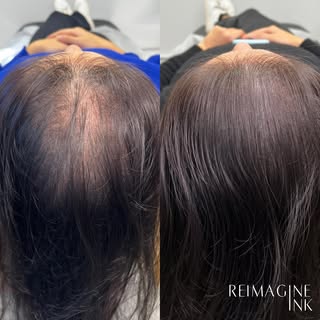 WHAT. A. DIFFERENCE. 🪄😱 This is a SMP density fill on a woman with thinning hair. She had a total 