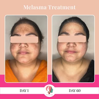 Struggling with melasma? We understand the frustration. But with the right treatment, there's hope!
