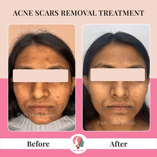 From acne scars to radiant confidence! We're incredibly proud to share this transformation at Puri S