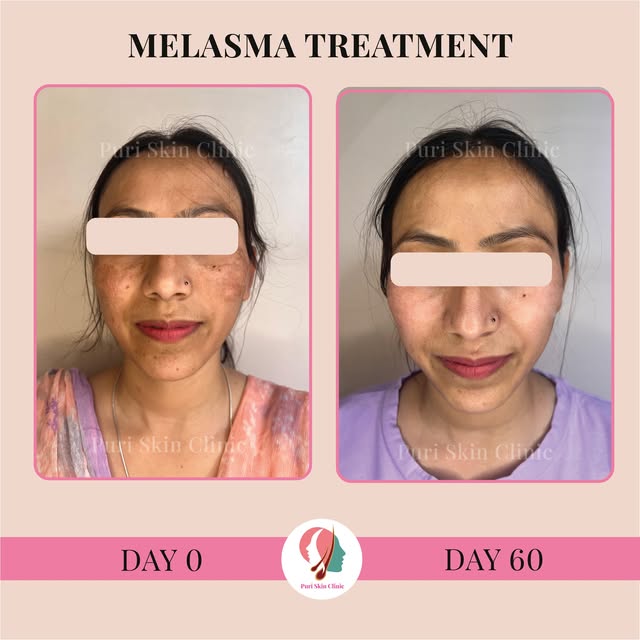 Melasma Success Story!
Another win at Puri Skin Clinic! 

Our patient regained their confidence with