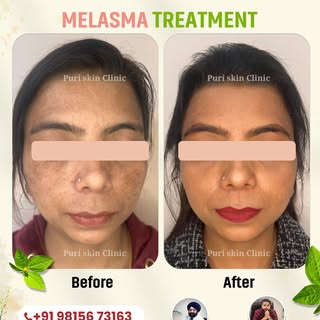 Say goodbye to stubborn pigmentation with our advanced Melasma Treatment at Puri Skin Clinic! 🌟 Wit