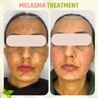 Wondering about Melasma Treatment in Ludhiana? At Puri Skin Clinic, our expert dermatologists provid