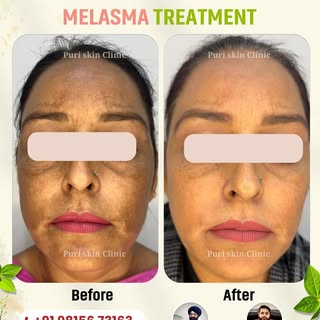 "Visible results speak for themselves ✨ At Puri Skin Clinic, our advanced melasma care emphasizes pe