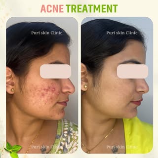 Real results, real confidence. At Puri Skin Clinic, our expert dermatologists provide advanced solut