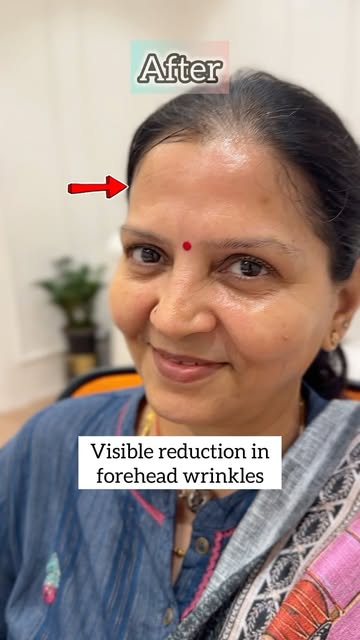 If your looking to get Botox contact: +91 99409 49300
No.27, vasu street, kilpauk.

#botox #kilpauk 
