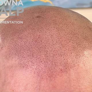 Third session for a lady with full alopecia. We were able to layer in successive layers of SMP going