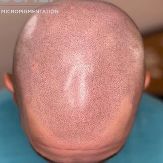 After several sessions layering on SMP we see a realistic look of a full head of hair. Happy to have