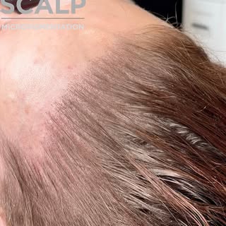 This client came to me with thinning hair after she had received a hair transplant some years earlie