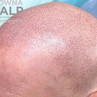 This client had complete alopecia. It was a big job but after several sessions she now has a natural