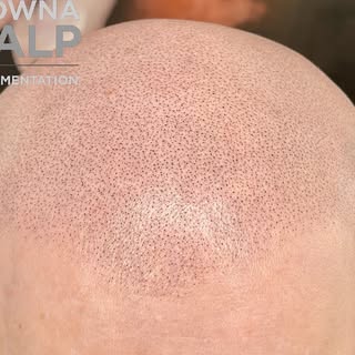 A last touchup for this wonderful lady with complete alopecia. We started by establishing her new ha