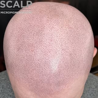 SMP Before and After. 

If your looking for a solution to your hair loss call or message to see if S