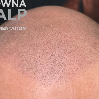 Fighting baldness one scalp at a time. Final touchup and another happy client. 

250-462-6978

#smpk