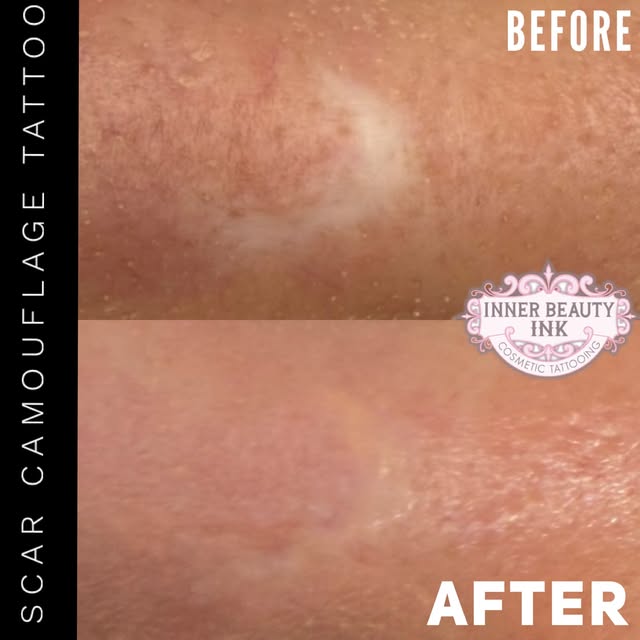 WHAT SCAR?
🥰
We are almost done camouflaging this client’s facial scar! I take these slow and gradu