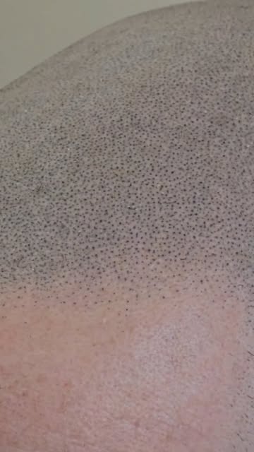 Micro Haar Pigmentatie 🔍
Een strakke, volle haarlijn – zonder operatie of littekens! 🙌
Met MHP cre