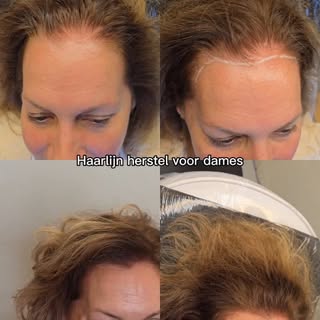 ✨ Voor & Na ✨Haarverdichting en haarlijn herstel met Micro Haar Pigmentatie!

Last van dunner worden