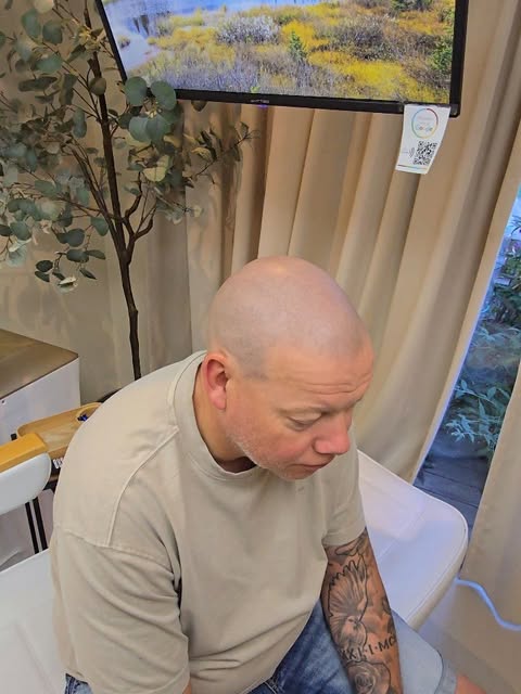 Healed result!
Alopecia full head with Mirco hair pigmentation!🔥🔍
Granular Technique combined with