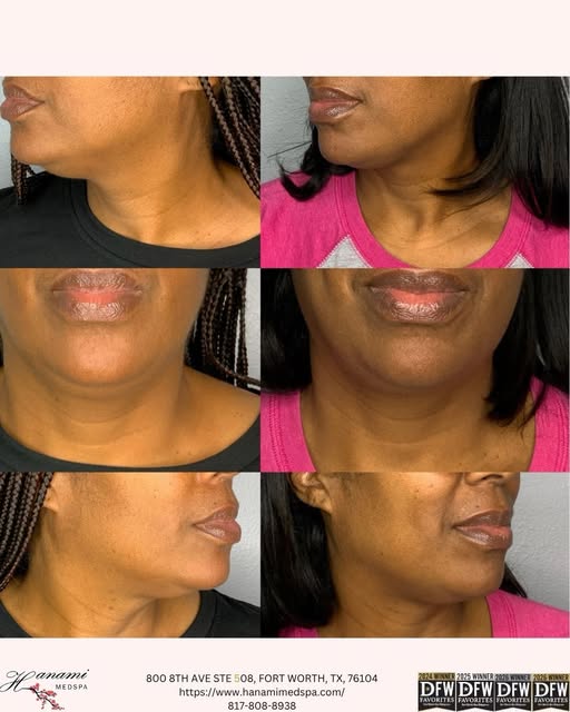 The power of consistency ✨
3 Kybella sessions. One goal: a more sculpted-looking chin and jawline.


