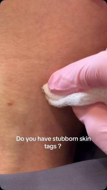 Say bye bye skintags! 

#skintag #skintagremoval #beauty #medspa #fortworthmedspa