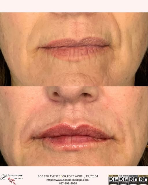 This treatment paired Restylane Kysse for the lips with Restylane Defyne for the nasolabial folds to