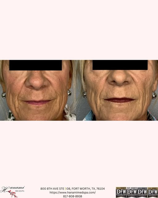This before-and-after showcases the power of cheek contouring with Radiesse® and Restylane® Contour.