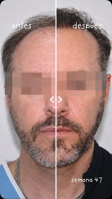 Tu cabello no tiene por qué definir cómo te ves. Hoy puedes empezar a cambiar la historia.

En KBAPE