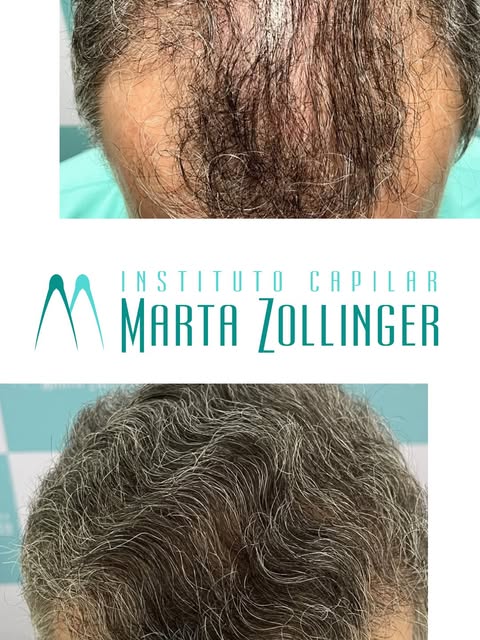 Arraste para o lado e acompanhe esse resultado 👉🏼

Calvície grau V
3400 unidades foliculares 
Resu