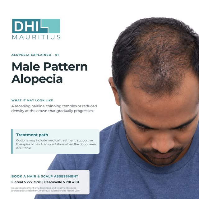 Male pattern alopecia is the most common cause of progressive hair loss in men. It is influenced by 