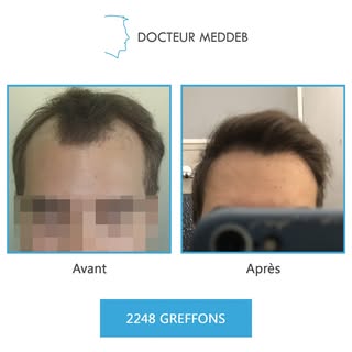 NW 3 - 26 ans - 2248 Greffons

Diamètre des cheveux : 52 microns
Densité zone donneuse : 80 UF/cm²


