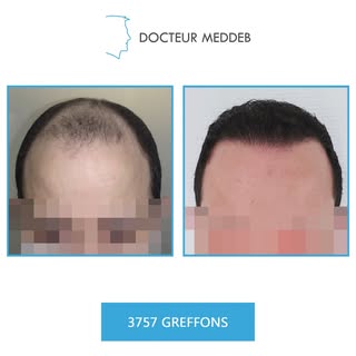 NW 4 - 37 ans - 3757 Greffons 

Diamètre des cheveux : 45 microns
Densité zone donneuse : 65 UF/cm²
