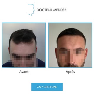NW 2 - 34 ans - 2277 Greffons 
Diamètre des cheveux : 50 microns
Densité zone donneuse : 90 UF/cm²
E