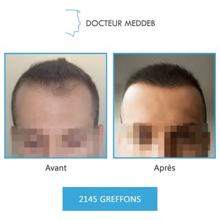 NW 2 - 28 ans - 2154 Greffons 

Diamètre des cheveux : 40 microns
Densité zone donneuse : 80 UF/cm²
