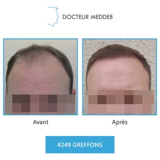 NW 4 - 38 ans - 4249 Greffons 
Diamètre des cheveux : 45 microns
Densité zone donneuse : 90 UF/cm²
E