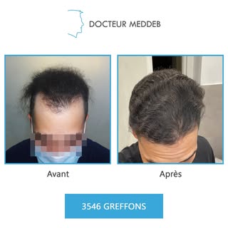 NW 4 - 31 ans – 4383 Greffons 

Diamètre des cheveux : 50 microns
Densité zone donneuse : 76 UF/cm²
