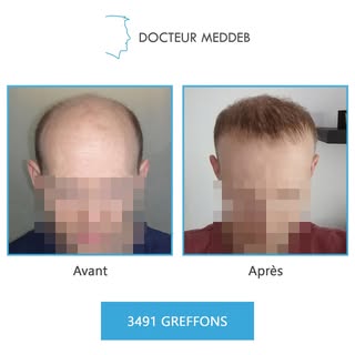 Norwood 6 - 31 ans - 3491 Greffons

Diamètre des cheveux : 45 microns
Densité zone donneuse : 80 UF/
