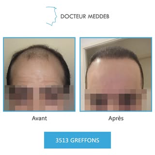NW 5 - 35 ans - 3513 Greffons 

Diamètre des cheveux : 50 microns
Densité zone donneuse : 80 UF/cm²

