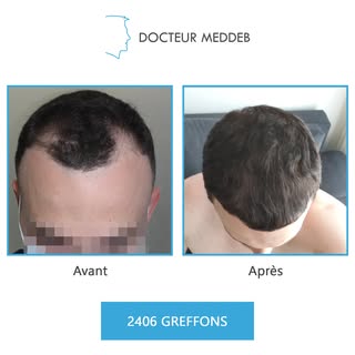 NW 2 - 27 ans - 2406 Greffons 

Diamètre des cheveux : 50 microns
Densité zone donneuse : 65 UF/cm²
